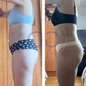 Antes y después de una clienta tras su proceso Real Balance