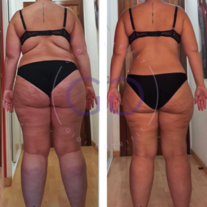 Antes y después de una clienta tras su proceso Real Balance
