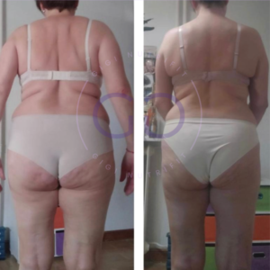 Antes y después de una clienta tras su proceso Real Balance