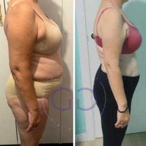 Antes y después de una clienta tras su proceso Real Balance