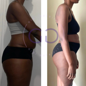 Antes y después de una clienta tras su proceso Real Balance
