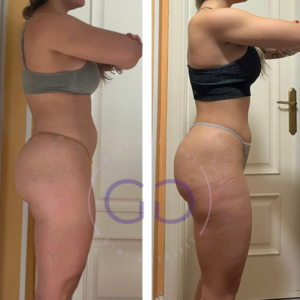 Antes y después de una clienta tras su proceso Real Balance