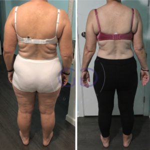 Antes y después de una clienta tras su proceso Real Balance